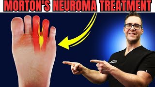 Numbness or Tingling in the Feet or Toes Mortons Neuroma Treatment [upl. by Odel900]