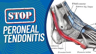 ResearchBacked Treatments for Peroneal Tendonitis Pain on the Outside of Your Foot When Running [upl. by Ytisahcal766]