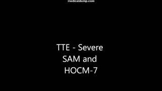 HOCM  Severe Systolic Anterior Motion of Mitral Valve Leaflet  TTE [upl. by Nylyaj]