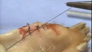 Introduction to Periodontal Surgery Techniques Initial Incisions and Suturing [upl. by Ylyl192]