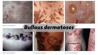 Bullous dermatoses [upl. by Oniger]