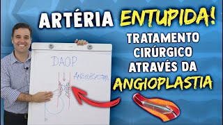 ARTÉRIA ENTUPIDA  TRATAMENTO CIRÚRGICO ATRAVÉS DA ANGIOPLASTIA [upl. by Alleunam]