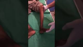 Demonstration of Sustained Ankle Clonus Dept of Medicine JNMC [upl. by O'Donnell]