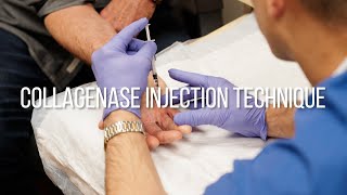 Collagenase Injection Technique for Dupuytrens Contracture [upl. by Marcela]