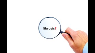 Is the level of fibrosis a reliable marker in myelofibrosis [upl. by Anyad501]