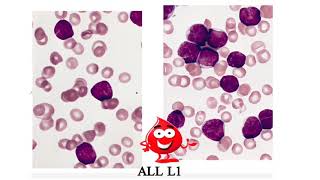 Hematology ⚶ Leukemia ALL Morphology HD [upl. by Lula]