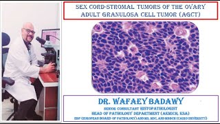 SEX CORD STROMAL TUMORS OF THE OVARY ADULT GRANULOSA CELL TUMOR BY DR WAFAEY BADAWY [upl. by Sydney]