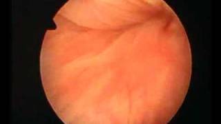 hysteroscopic aspect of adenomyosis [upl. by Kati]