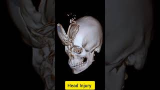 Frontal Bone Injury doctor neet medicalimaging medicaltest [upl. by Furtek893]