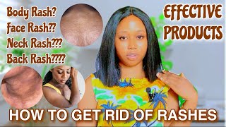 HOW TO GET RID OF RASHES Face Rashes Back Rashes EFFECTIVE PRODUCTS THAT GETS RID OF RASHES [upl. by Leese]