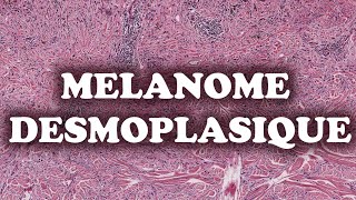 LE MELANOME DESMOPLASIQUE  PATHOLOGIE [upl. by Chuipek]