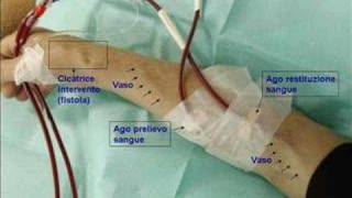 fistola AV per dialisi [upl. by Ennylyak]