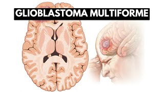 Inside Glioblastoma Multiforme A Journey into the Deadliest Brain Tumor [upl. by Eizdnil]