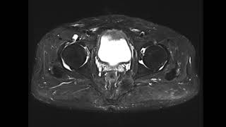 Iliopsoas bursitis [upl. by Calendra573]