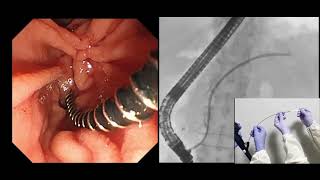 Pancreatic stent removal with a novel drill dilator [upl. by Rind]