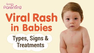 Common Viral Rashes in Babies  Types Signs and Treatement [upl. by Dyer]