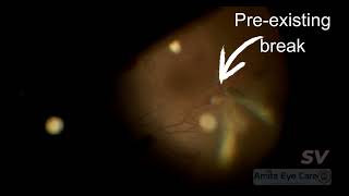 Vitrectomy for SLE Retinopathy [upl. by Reitrac]