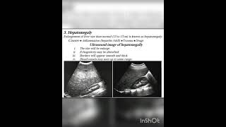 Hepatomegalyits causes and sonographic image [upl. by Frederigo]