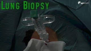 Lung biopsy [upl. by Chrisoula482]