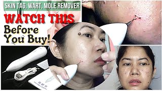 Beauty Mole Removal Sweep Spot Pen  Removal Of Warts Moles Etc  Effective Skin Tag Remover [upl. by Nnaer]