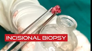 How to take an incisional biopsy with a scalpeloral mucosa biopsybiopsy video [upl. by Ennayram]