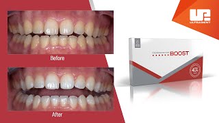 What to Expect with Opalescence Boost Professional Teeth Whitening [upl. by Eivol]