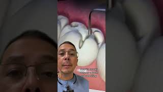 How Does a Dentist Fill a Cavity  View Mobile Dental [upl. by Chapen720]