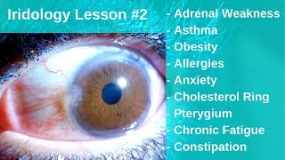 Iridology Lesson  Gland Weaknesses Allergies Anxiety Fatigue Asthma and How to Heal [upl. by Justin]