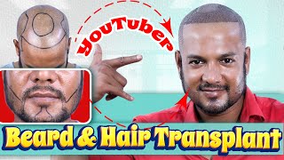 YouTubers Hair amp Beard Transplant Journey 😎  Hair Transplant in Bangladesh  New Roots [upl. by Nylahsoj]