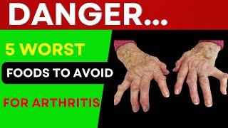 AVOID These 5 Inflammatory Foods for Osteoarthritis [upl. by Alorac]