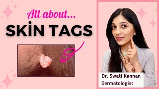 Skin Tags Causes Myths and the Best Removal Methods Explained by a Dermatologist [upl. by Leunamnauj]