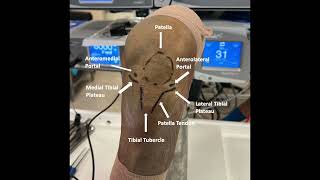 In Office Needle Arthroscopy of the Knee With Lateral Parapatellar Retinacular Release [upl. by Tletski]