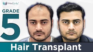 Hair Transplant Before amp After  6 Month Results  3500 Grafts transplanted in Front and Hairline [upl. by Leela]