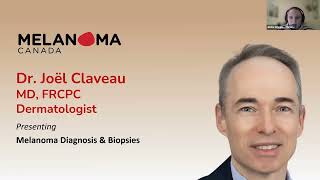 Melanoma Diagnosis amp Biopsies [upl. by Qiratla]