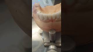 Proteza scheletata cu capse dental [upl. by Iruj]