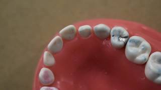 Class 2 Amalgam Restoration for Primary Tooth [upl. by Durwin693]