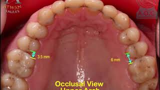 Amazing orthodontic treatment of Cl II div 2 with invisible braces  Omar 48 ys [upl. by Anaya]