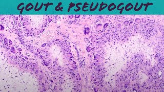 Gout amp Pseudogout calcium pyrophosphate deposition disease  chondrocalcinosis pathology USMLE [upl. by Aititil]