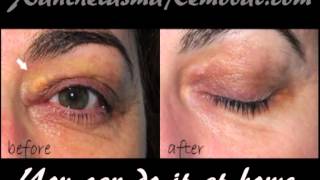 Xanthelasma removal at home [upl. by Cybill13]