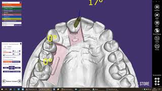 exocad  Rattrapage daxe [upl. by Anial]