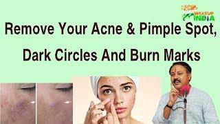 Remove your acne pimple spot dark circles and burn marks  Rajiv Dixit [upl. by Zurc560]