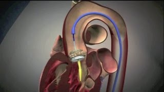 Transcatheter Aortic Valve Implantation TAVI [upl. by Vladamar]