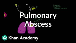 Pulmonary abscess  Respiratory system diseases  NCLEXRN  Khan Academy [upl. by Maclean]