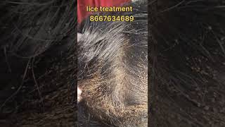 How to remove nits and lice treatment nits hair headlice haircare lice nits and lice removal [upl. by Swaine965]