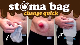 How to change an ostomy bag — quicker than 1 minute [upl. by Ennovehc798]