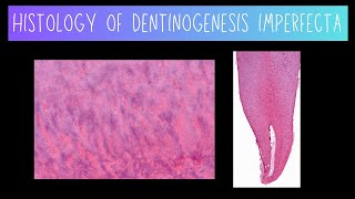 Histology of Dentinogenesis Imperfecta [upl. by Ydoow]