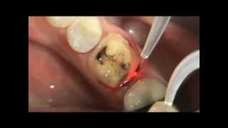 PHILIPS LASERS Eviction gingivale 3wmv [upl. by Ashli]