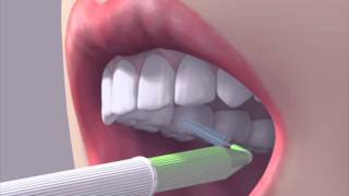 How to use an interdental brush [upl. by Hgielsel]