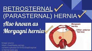 Morgagni Hernia Explained  Retrosternal amp Parasternal Hernia  Novice Medic [upl. by Amat493]