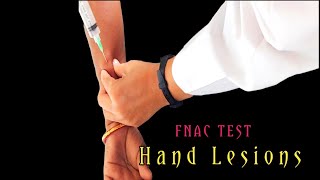 FNAC Test For Hand Lesions।। [upl. by Anos335]